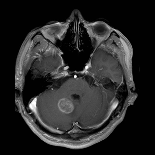 右侧小脑见圆形低密度影，MRI上T1WI呈低信号，T2WI呈等及高信号，FLAIR呈稍高及稍低信号，DWI呈低信号，ADC呈高信号，增强扫描呈环状强化大小约2.4X2.7cm，周围见少许片状水肿影