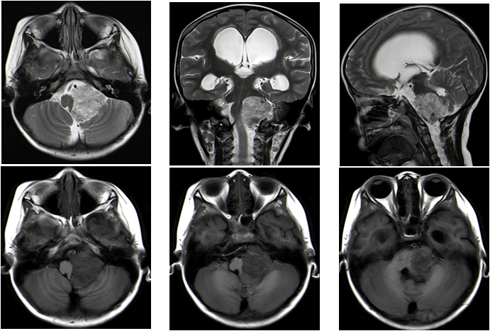 左侧桥小脑角区实性占位，呈分叶状，边界清楚，CT平扫等密度，其内混杂高密度钙化灶
