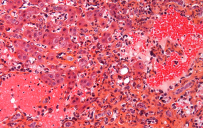 肝右后叶见一较大团块状稍低密度影，大小约12.7x9.2cm，部分突出于肝脏轮廓，增强扫描动脉期斑片状明显强化，门脉期及平衡期可见延迟强化。由于病变体积较大，不能除外恶性。虽然病人无肝炎病史，但仍不能除外肝细胞癌或胆管细胞癌可能，其它少见恶性疾病如肝脏血管肉瘤也应该在考虑范围之内