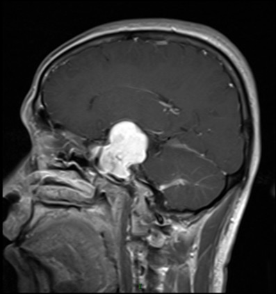 MRI平扫加增强示鞍区、右侧中颅窝可见巨块状异常信号影，似类哑铃型，大小约6.6cm×4.3cm×4.7cm，T1WI呈低信号，T2WI呈高信号，其内见少许短T1信号影，右侧海绵窦区受累，增强后呈明显均匀强化