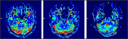 右侧颞叶类圆形长T1稍长T2信号影，信号均匀， DWI肿瘤弥散未受限，增强扫描均匀明显强化，邻近脑膜强化， PWI肿瘤呈低灌注 。