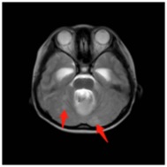 小脑蚓部见团块状异常信号，突向四脑室，前方可见脑脊液信号环绕，T1WI呈稍低信号，T2WI呈稍高信号，DWI呈稍高信号，增强扫描呈不均匀斑片状强化，病灶内部可见斑片状囊性信号;双侧小脑半球另见多发结节样稍长T1稍长T2信号，明显结节样强化