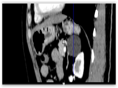 左侧肾上腺见类圆形稍低密度影，边缘光滑，密度均匀，平扫CT值约15HU，二期增强扫描囊内未见明显强化，囊壁可见轻度强化