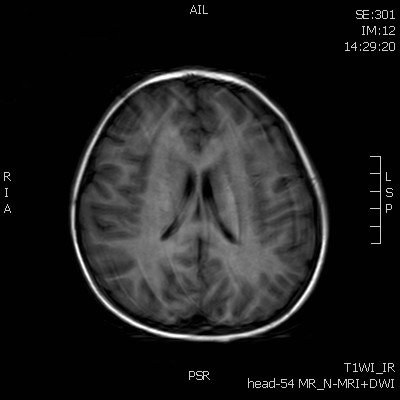 脑干、双侧丘脑、基底节区、放射冠及额颞顶叶皮层下见多发斑片状稍长T1稍长T2信号，FLAIR呈高信号，颈髓中央区分布，DWI未见明显高信号。