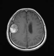 右侧额颞部脑外可见巨大团片状占位性病变，信号混杂，T1WI呈低及高信号，T2WI呈高及低信号，FLAIR呈稍低及稍高信号，DWI呈高信号，ADC呈稍高信号，增强扫描未见明显强化