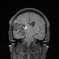 右侧额颞部脑外可见巨大团片状占位性病变，信号混杂，T1WI呈低及高信号，T2WI呈高及低信号，FLAIR呈稍低及稍高信号，DWI呈高信号，ADC呈稍高信号，增强扫描未见明显强化