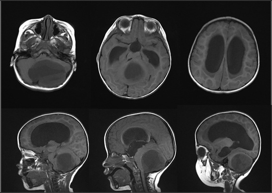 左侧小脑半球、小脑蚓部以囊性成分为主的巨大囊实性占位病变。CT平扫密度不均，以低密度为主，肿瘤边界清楚，临近骨质受压变薄，第四脑室受压移位。MRI平扫：长T1、长T2信号为主，第四脑室受压移位，瘤周水肿不明显，FLAIR序列上实质成份呈不均匀稍高信号，DWI上呈稍低或等信号，增强扫描病灶呈不规则环形强化，壁厚薄不均，内壁凹凸不平