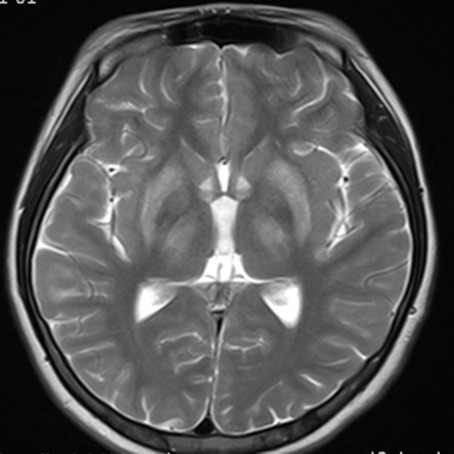 丘脑核磁共振图图片